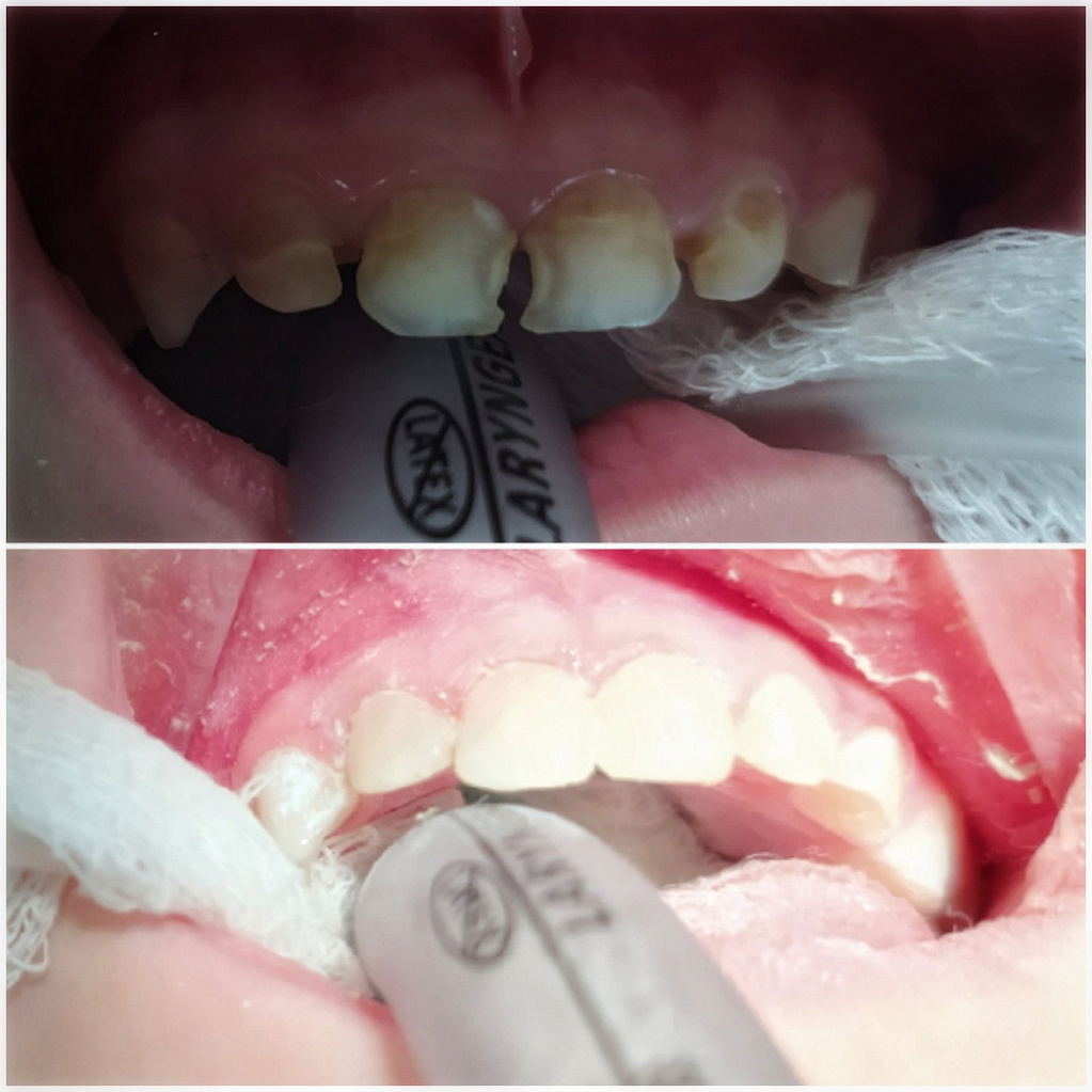 Зубы до и после лечения.
