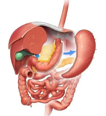 Рукавная резекция желудка (Sleeve gastrectomy (LSG)) .jpg