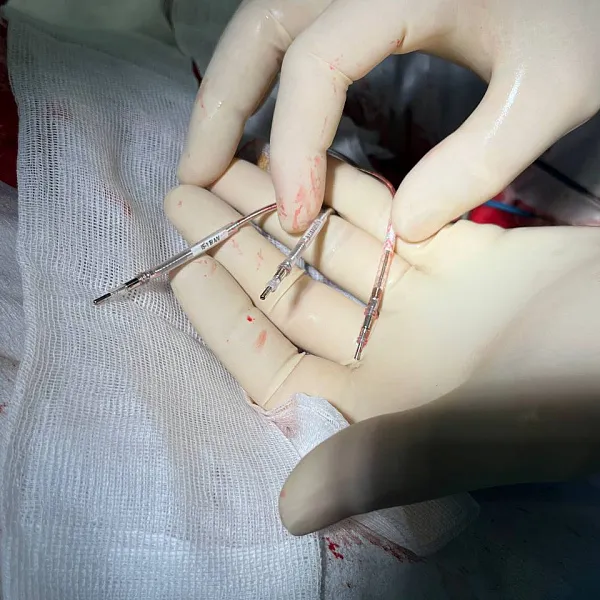 В Университетской клинике провели серию уникальных операций на сердце - фото 3