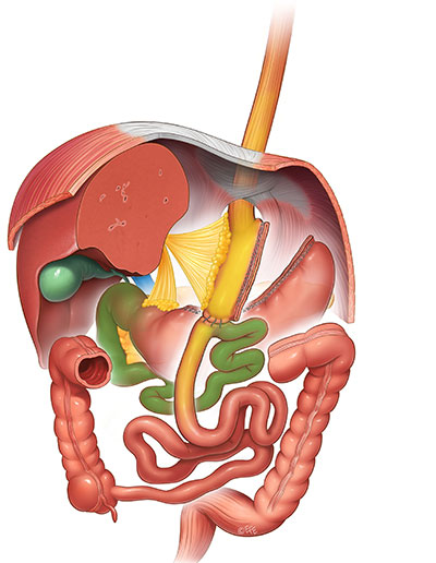 Минигастрошунтирование   (mini gastric bypass (MGB)).jpg