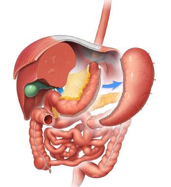 Рукавная резекция желудка (Sleeve gastrectomy (LSG)) .jpg